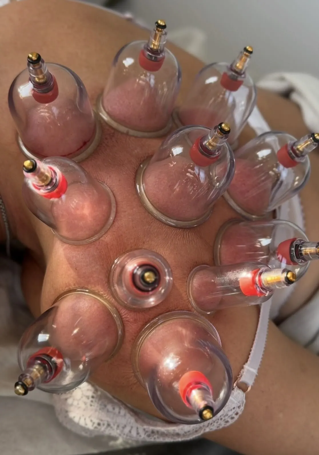 massage-ventouses-_1_ ventouses